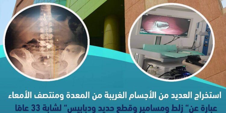 استخراج زلط وحديد ومسامير من معدة فتاة بمستشفى طيبة التخصصى بالأقصر