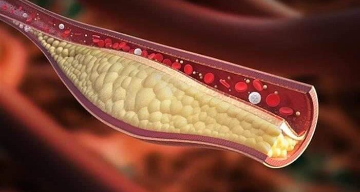 الألم الشديد” قد يكون علامة تحذيرية لارتفاع مستويات الكوليسترول في الدم