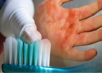 .. حقيقة تخفيف معجون الأسنان آلام الحروق الجلدية …