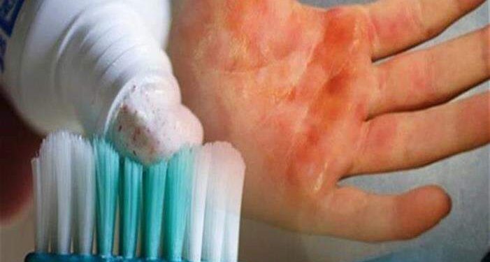 .. حقيقة تخفيف معجون الأسنان آلام الحروق الجلدية …