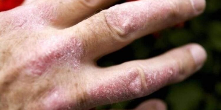 أسباب تقشر الجلد تعرف عليها …