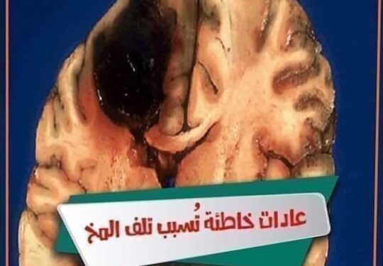 الأسباب الرئيسية المسببة لتلف العقل