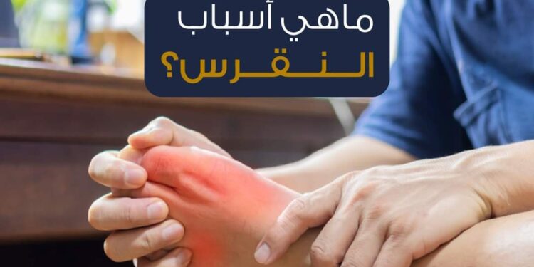 ما هي أسباب النقرس؟