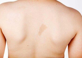 علام تدل بقع “القهوة بالحليب” على جسد الأطفال؟