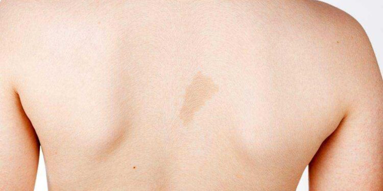 علام تدل بقع “القهوة بالحليب” على جسد الأطفال؟