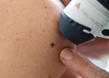 إزالتها تسبب السرطان”… طبيب روسي يبدد 3 أساطير حول الشامة