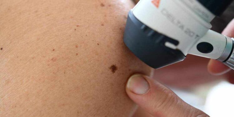 إزالتها تسبب السرطان”… طبيب روسي يبدد 3 أساطير حول الشامة