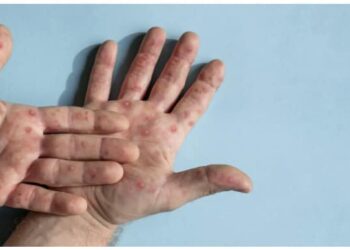 ماذا تعرف عن جدري القرود؟!!