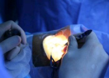 انهاء الطبيب الزائر عمليات القرنية بمستشفي بنغازي التعليمي لطب وجراحة العيون