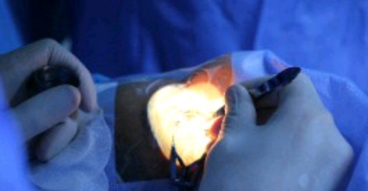 انهاء الطبيب الزائر عمليات القرنية بمستشفي بنغازي التعليمي لطب وجراحة العيون