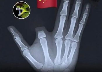 رجل يقطع إصبعه بيده بعد لدغة ثعبان أسطوري.. المفاجأة في المستشفى!